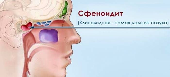Причины, симптомы и методы лечения сфеноидита
