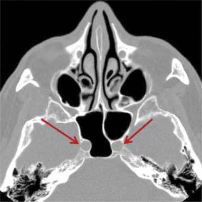 Лечение сфеноидита